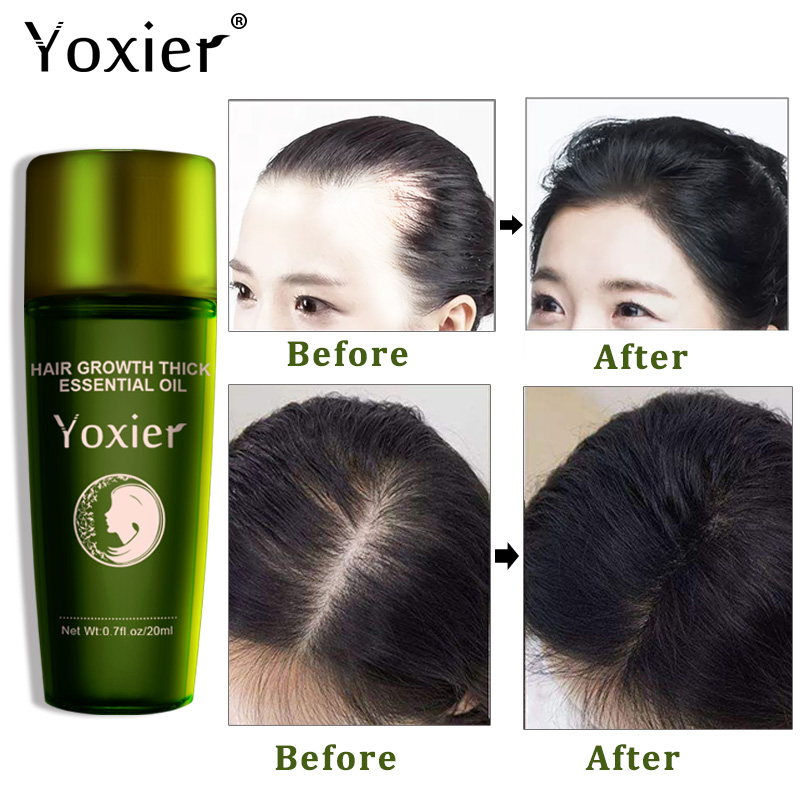 Yoxier Herbal Hair Growth Esse - Hair Care Herbal Products review and price